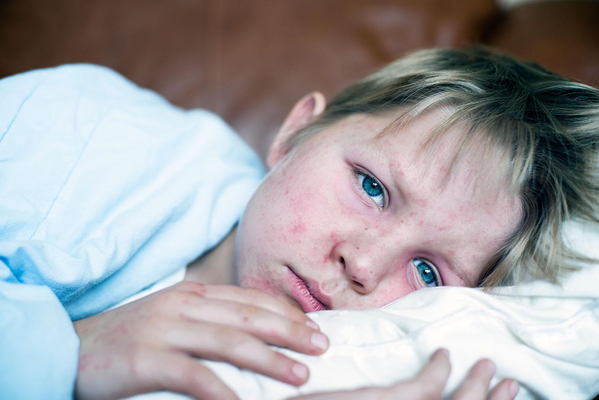 Measles Adoloscent
