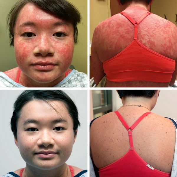 Psoriasis Therapy Gives Teen Her Life Back