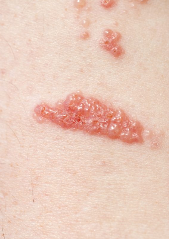 5 ways to treat and prevent poison ivy rash Inside Children's Blog