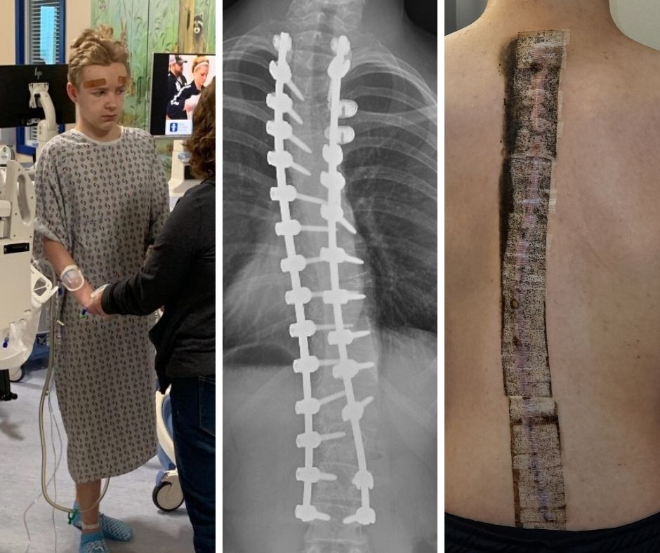 Halo traction therapy and spinal fusion surgery mean more ‘airtime’ for