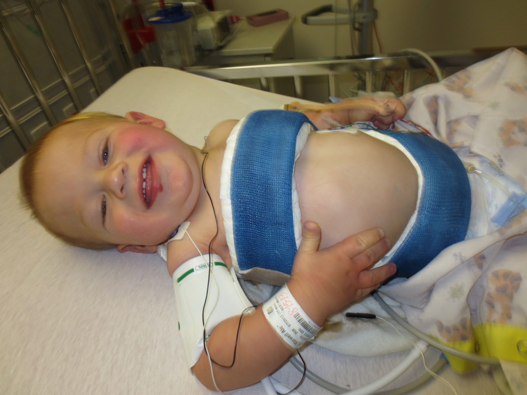Casting helps Solon boy conquer scoliosis without surgery : Inside ...
