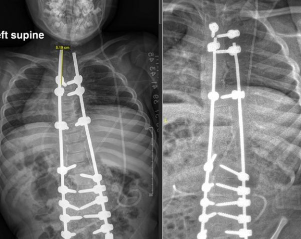 Shillla Rods Shilla (growth) rods allow young scoliosis patient to continue to grow ...