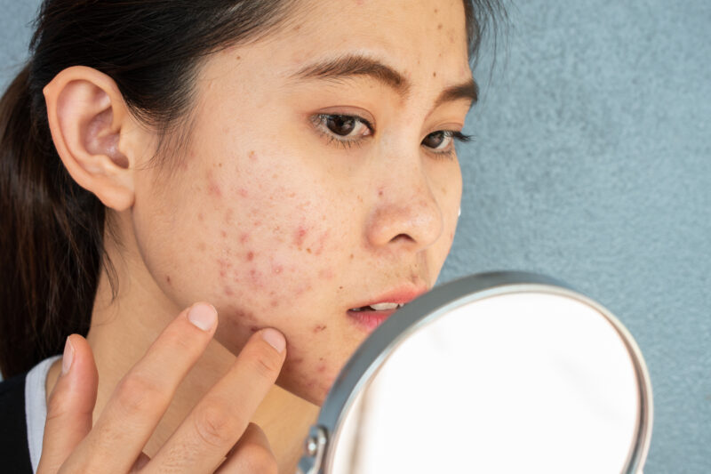 When should I contact a doctor about my teen’s acne?