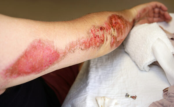 treating road rash