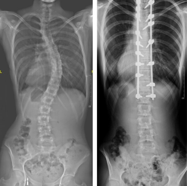 Sleeping With Scoliosis and Spinal Fusion