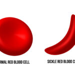 What is sickle cell disease?