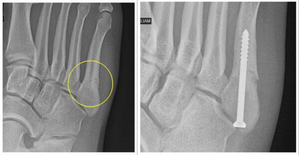 Jones fracture