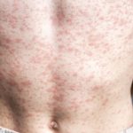 GettyImages-measles torso sized for blog