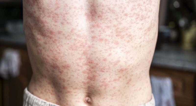 GettyImages-measles torso sized for blog