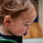 Measles FAQ for parents Children viral disease or allergies. Red measles rash on baby.
