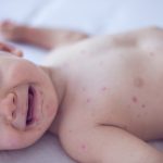 Crying baby girl with measles