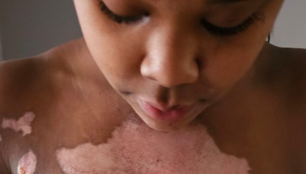 Gianna Ivery - chest burn