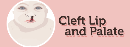 Cleft Lip and Cleft Palate