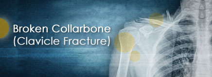 Broken Collarbone (Clavicle Fracture)
