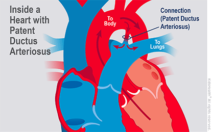 Kidshealth: Patent Ductus Arteriosus (PDA) | Akron Children's Hospital