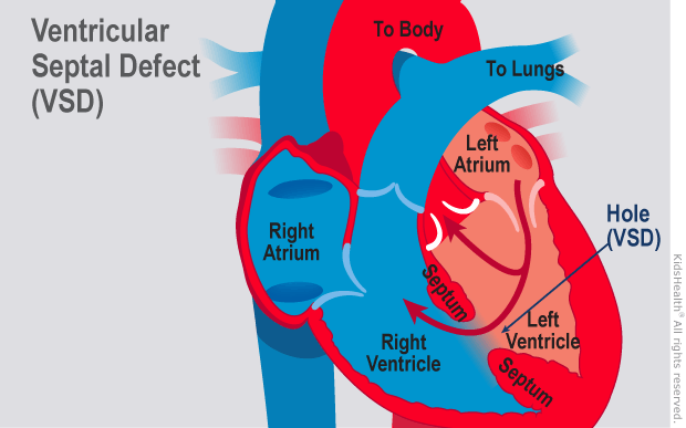 Kidshealth: Ventricular Septal Defect (VSD) | Akron Children's Hospital