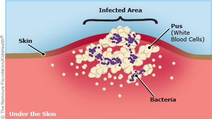 Illustration shows how bacteria under the skin can cause an infection