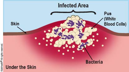 Diagram showing bacteria and pus under the skin, forming an abscess.