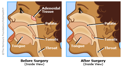 adenoidectomy illustration