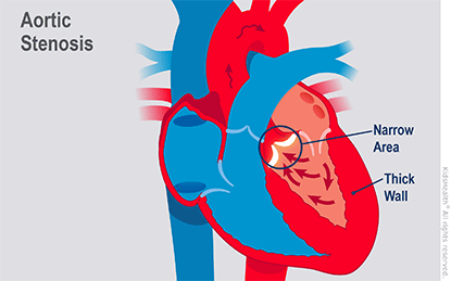 Inside a heart with aortic stenosis where the aortic valve is too narrow.