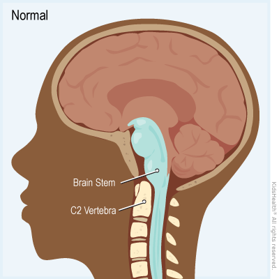 Illustration shows normal brain anatomy without basilar invagination