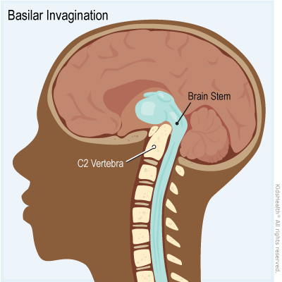 Illustration shows brain with basilar invagination