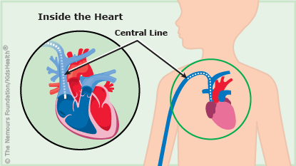 A central line is shown under a child's skin near the heart.