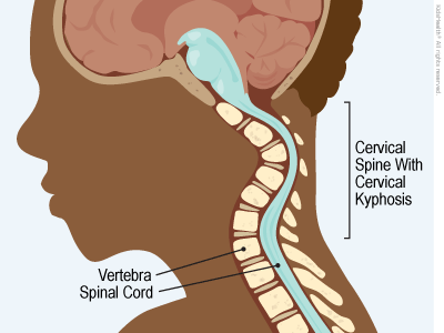 Illustration: Cervical Kyphosis