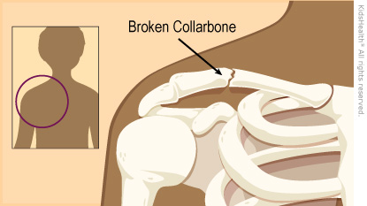 Illustration: Broken Collarbone