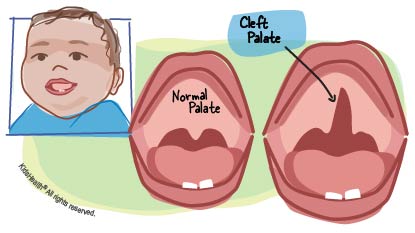 Diagram showing how a cleft palate differs from a normal palate, as described in the article