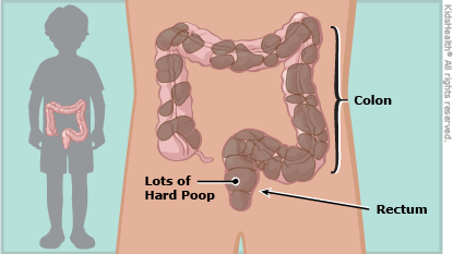 Kidshealth: A to Z: Constipation | Akron Children's Hospital