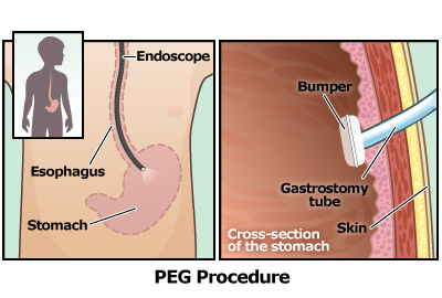 gastrostomy_PEG