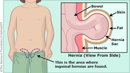 Drawing shows an inguinal hernia viewed from the side