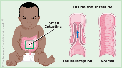 A look inside the intestine with and without intussusception
