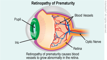 ROP retinopathy of prematurity illustration