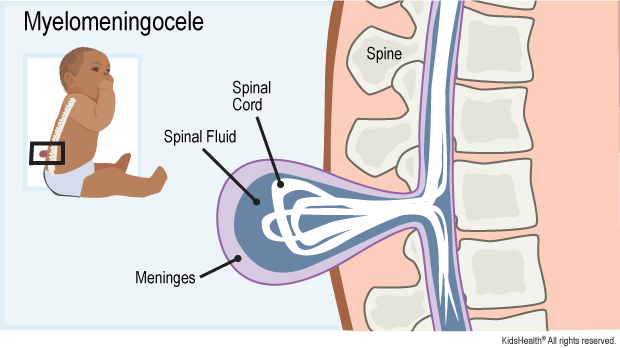 Diagram labels spine, spinal cord, spinal fluid, meninges. Shows myelomeningocele pushing through a gap in the spine