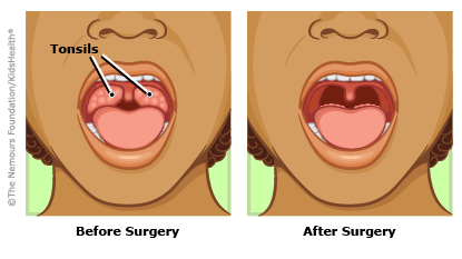 Tonsillectomy before and after