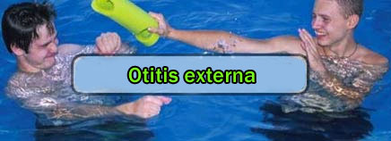 Otitis del nadador (otitis externa)