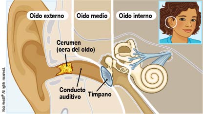 Ilustración del oído externo, del oído medio y del oído interno que muestra el cerumen (también llamado "cera del oído") en el canal auditivo que conduce al tímpano, de la manera que se explica en el artículo.