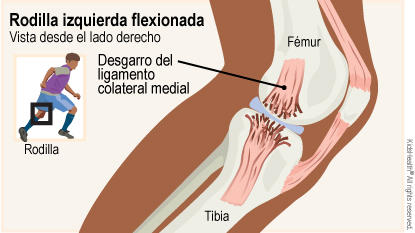 El diagrama muestra una rodilla izquierda flexionada vista desde el lado derecho e indica la ubicación del ligamento colateral medial, el fémur y la tibia. 