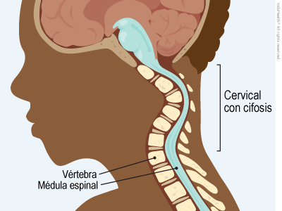 Illustration: Cervical Kyphosis