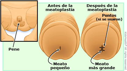 Illustration: meatoplasty