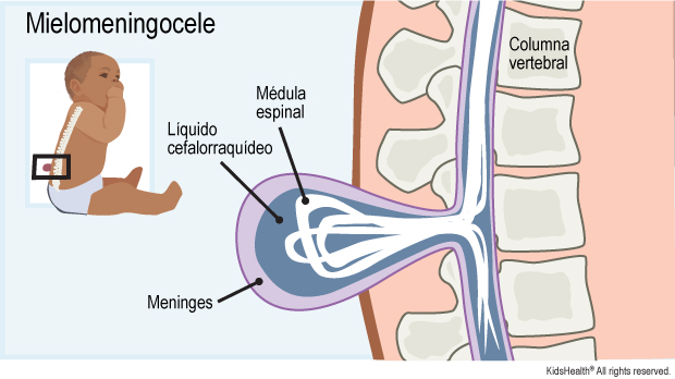 La ilustración indica la ubicación de la columna vertebral, la médula espinal, el líquido cefalorraquídeo y las meninges. Muestra la mielomeningocele metiéndose en el espacio vacío de la columna vertebral.