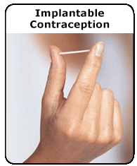 Birth Control, Implantable Contraception female