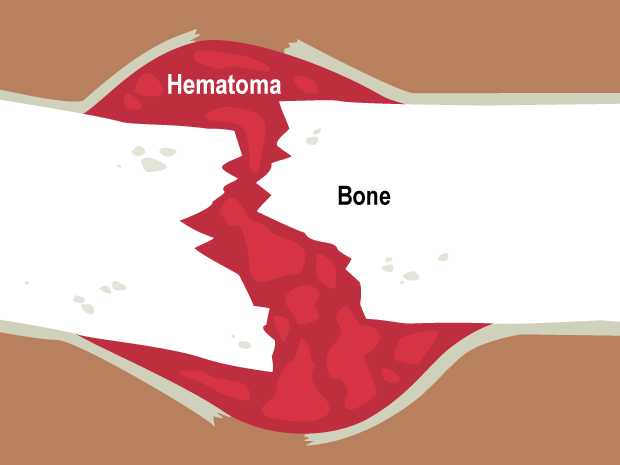 As soon as a bone breaks, a hematoma (blood clot) forms around the broken bones. The hematoma protects the bones and delivers the cells needed for healing.