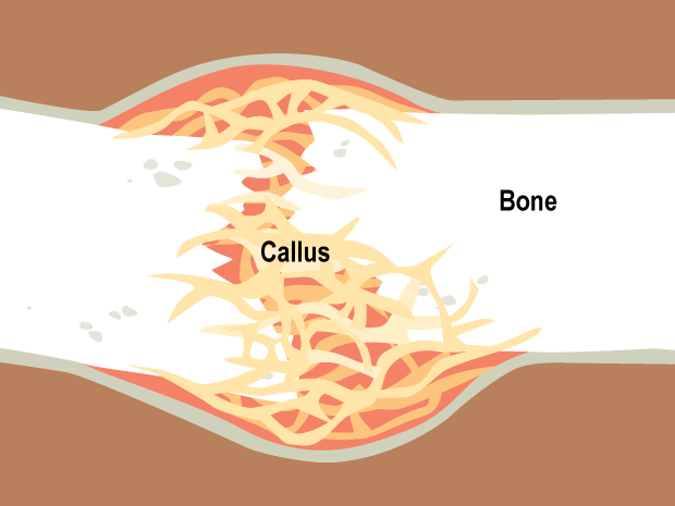 After about a week, a type of bone called a callus starts to form. It's soft at first, but becomes harder. Over the next few weeks, the callus replaces the hematoma.