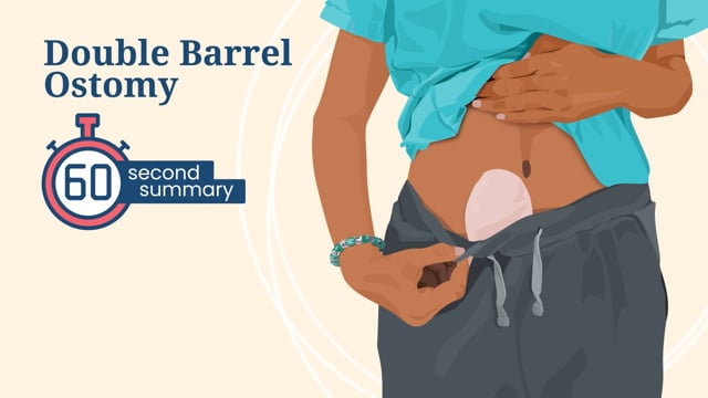 60 Second Summary: Double Barrel Ostomy