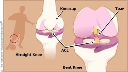torn ACL illustration