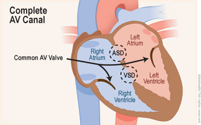 Diagram of complete atrioventricular canal shows right atrium and right ventricle, left ventricle, left atrium, ASD, VSD and common atrioventricular valve. 