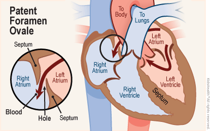 Two close-up diagrams (one a super close-up) show a patent foramen ovale — where blood continues to flow from the left atrium into the right atrium through a hole in the septum which normally closes after birth.